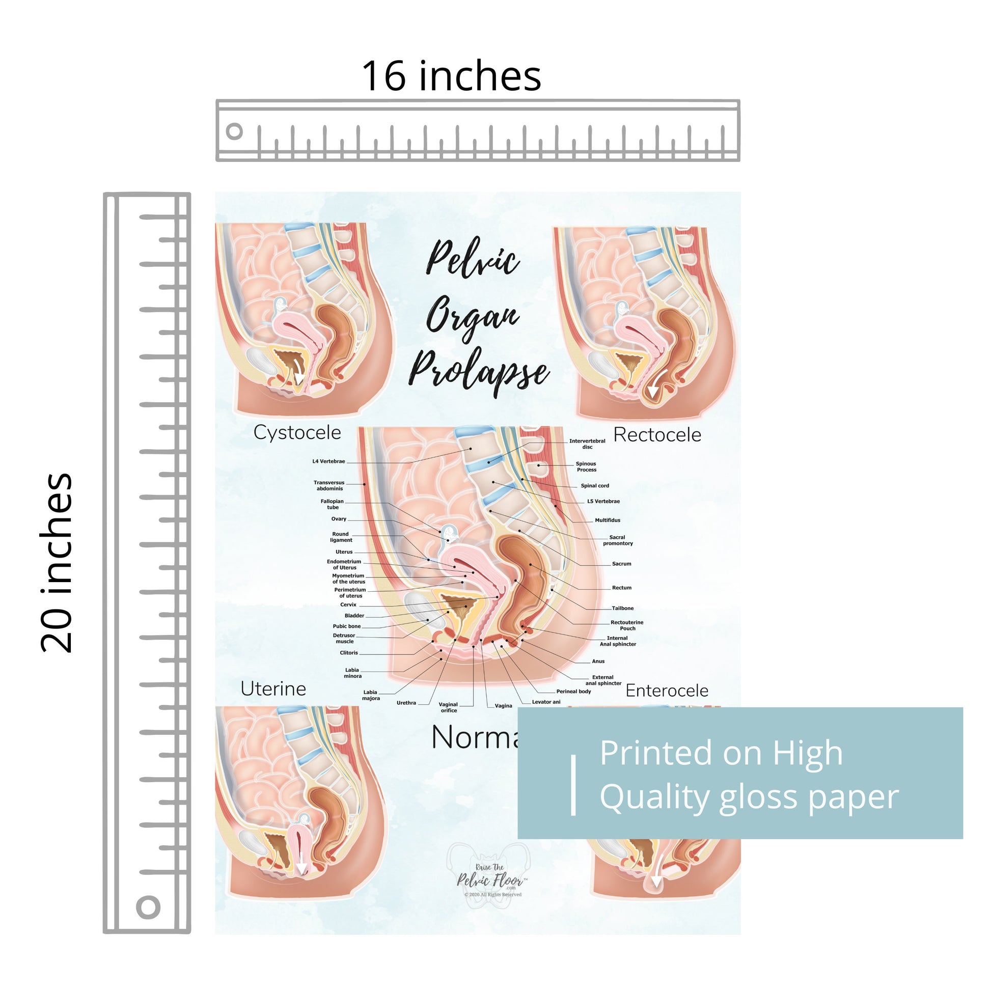 Prolapse Bladder, Rectum, Uterus, Intestine Art Print | Cystocele, Rectocele, Uterine Prolapse and Enterocele | Pelvic Floor