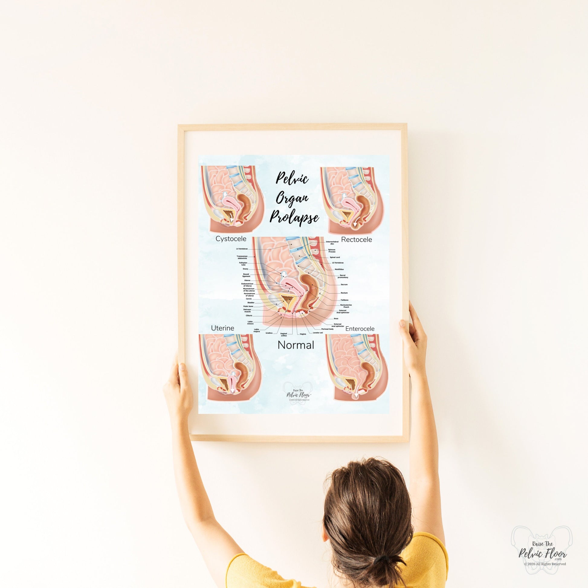 Prolapse Bladder, Rectum, Uterus, Intestine Art Print | Cystocele, Rectocele, Uterine Prolapse and Enterocele | Pelvic Floor