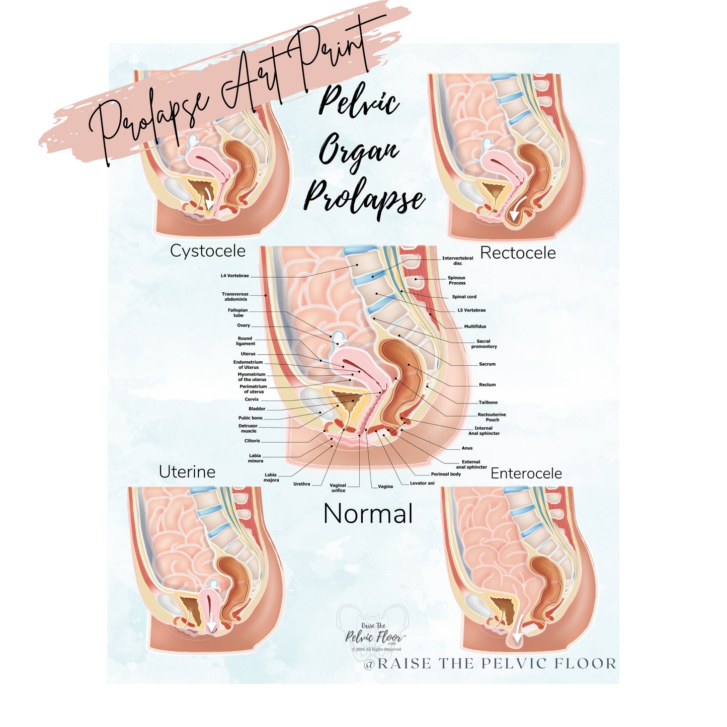 Prolapse Bladder, Rectum, Uterus, Intestine Art Print | Cystocele, Rectocele, Uterine Prolapse and Enterocele | Pelvic Floor