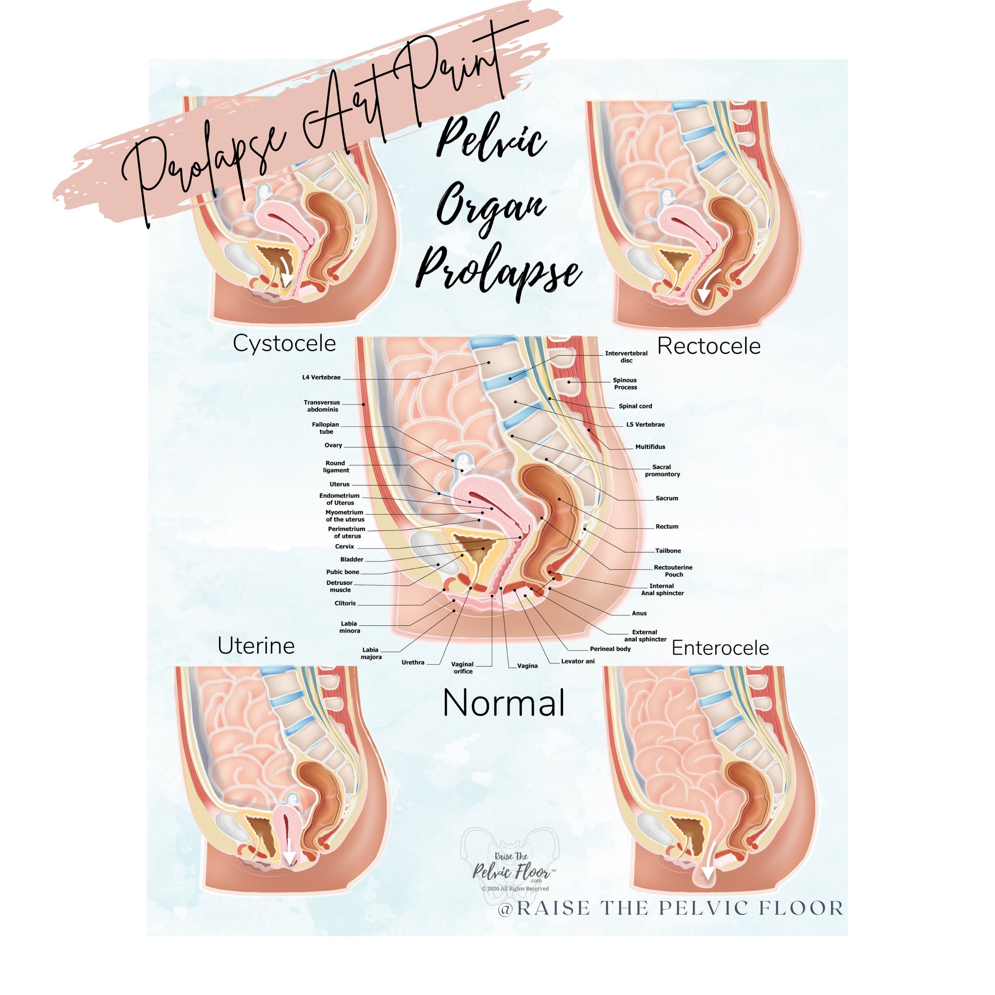 Prolapse Bladder, Rectum, Uterus, Intestine Art Print | Cystocele, Rectocele, Uterine Prolapse and Enterocele | Pelvic Floor