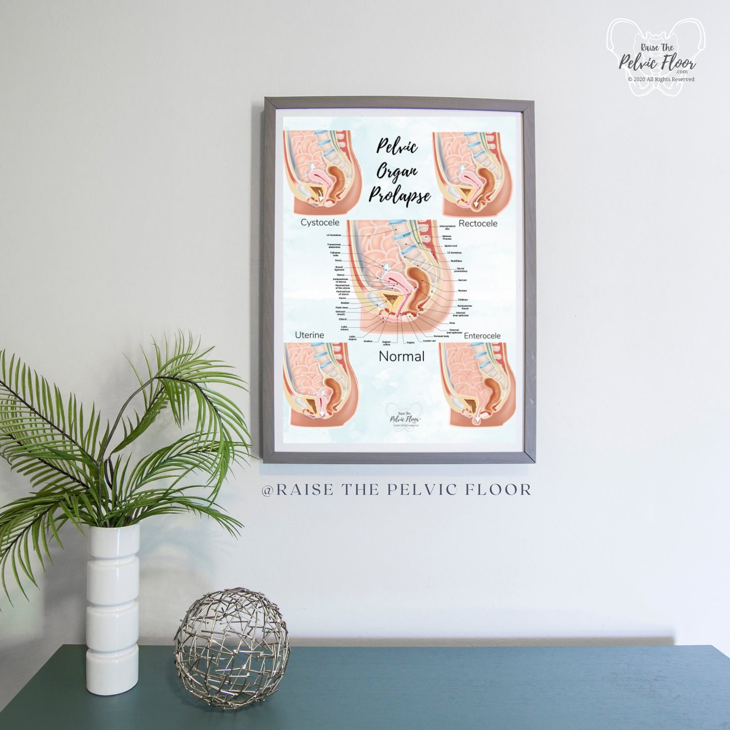 Prolapse Bladder, Rectum, Uterus, Intestine Art Print | Cystocele, Rectocele, Uterine Prolapse and Enterocele | Pelvic Floor