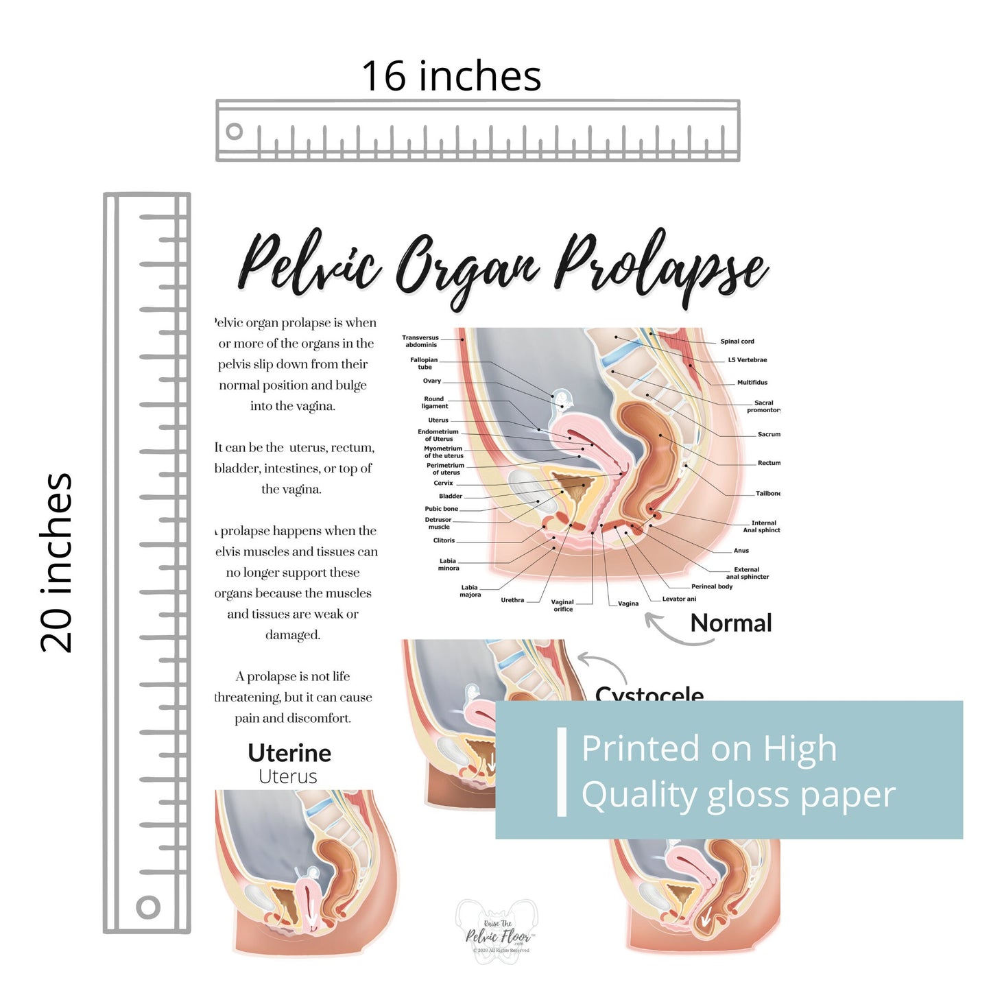 Prolapse Definition Art Print of Bladder, Rectum, & Uterus | Cystocele, Rectocele, and Uterine Prolapse | Pelvic Floor *Cultural Diversity