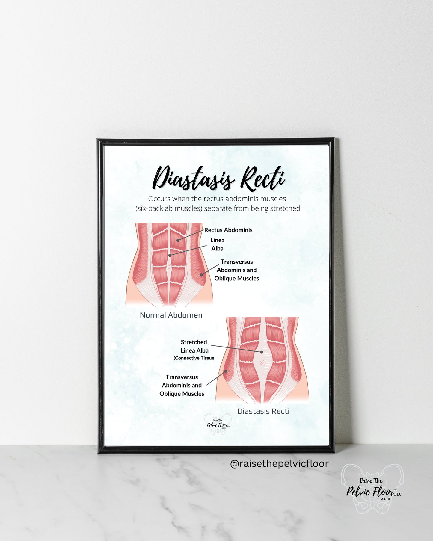 Diastasis Recti Pelvic Floor Art Poster | Postpartum, Pregnancy, Pelvic Floor Physical Therapist | Pelvic floor anatomy health
