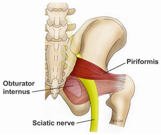 Understanding Piriformis Syndrome: Causes, Symptoms, and Treatment