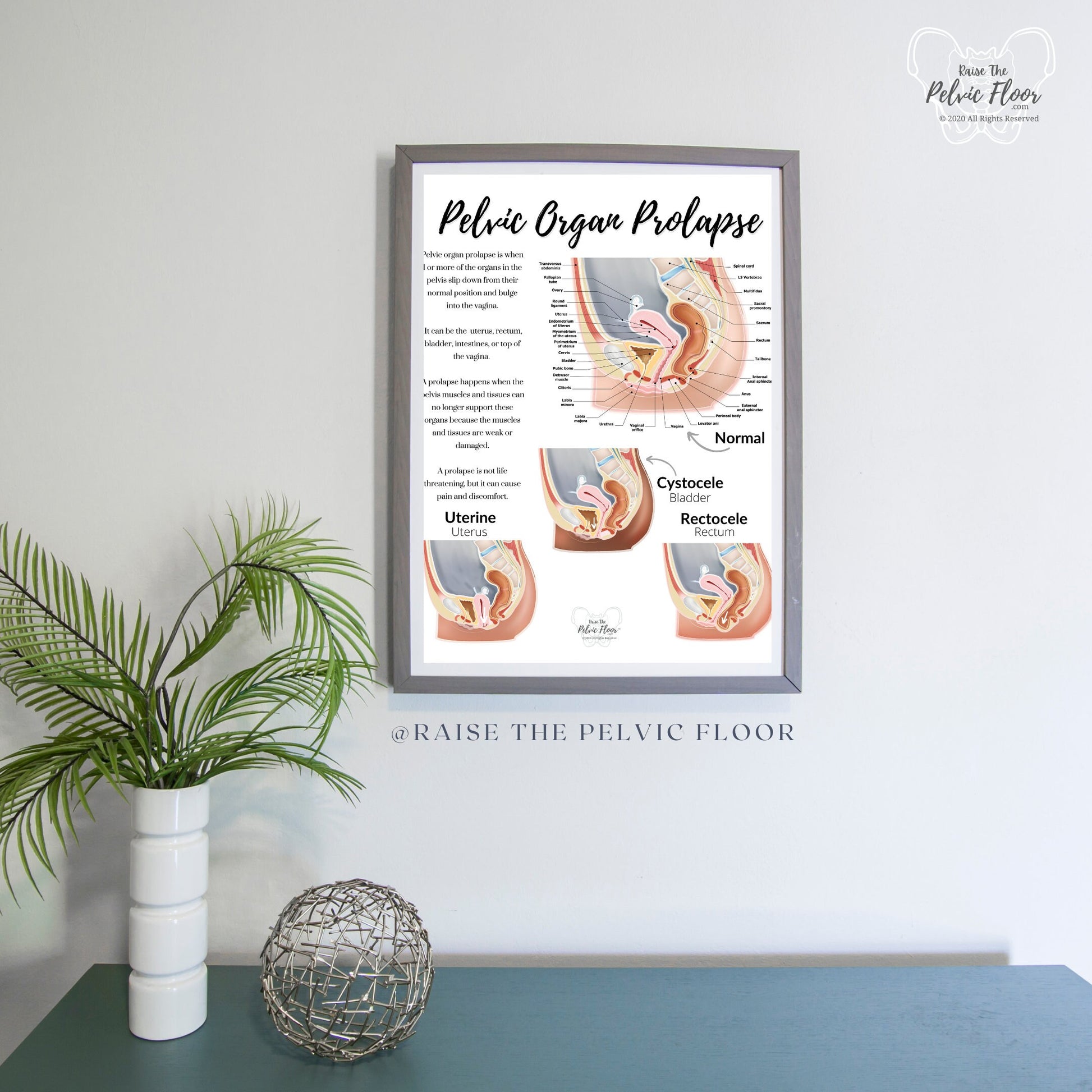 Prolapse Definition Art Print of Bladder, Rectum, & Uterus | Cystocele, Rectocele, and Uterine Prolapse | Pelvic Floor *Cultural Diversity