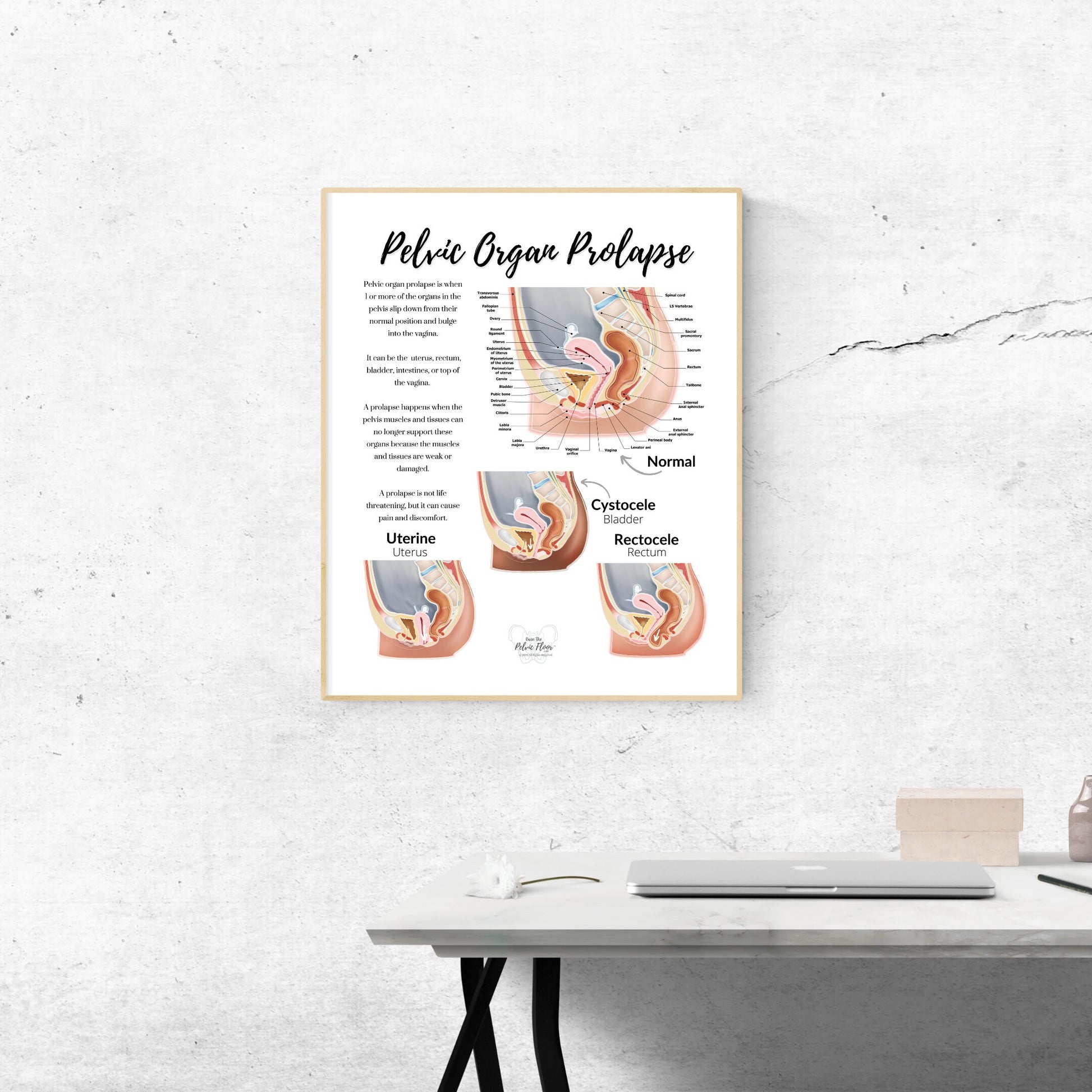 Prolapse Definition Art Print of Bladder, Rectum, & Uterus | Cystocele, Rectocele, and Uterine Prolapse | Pelvic Floor *Cultural Diversity