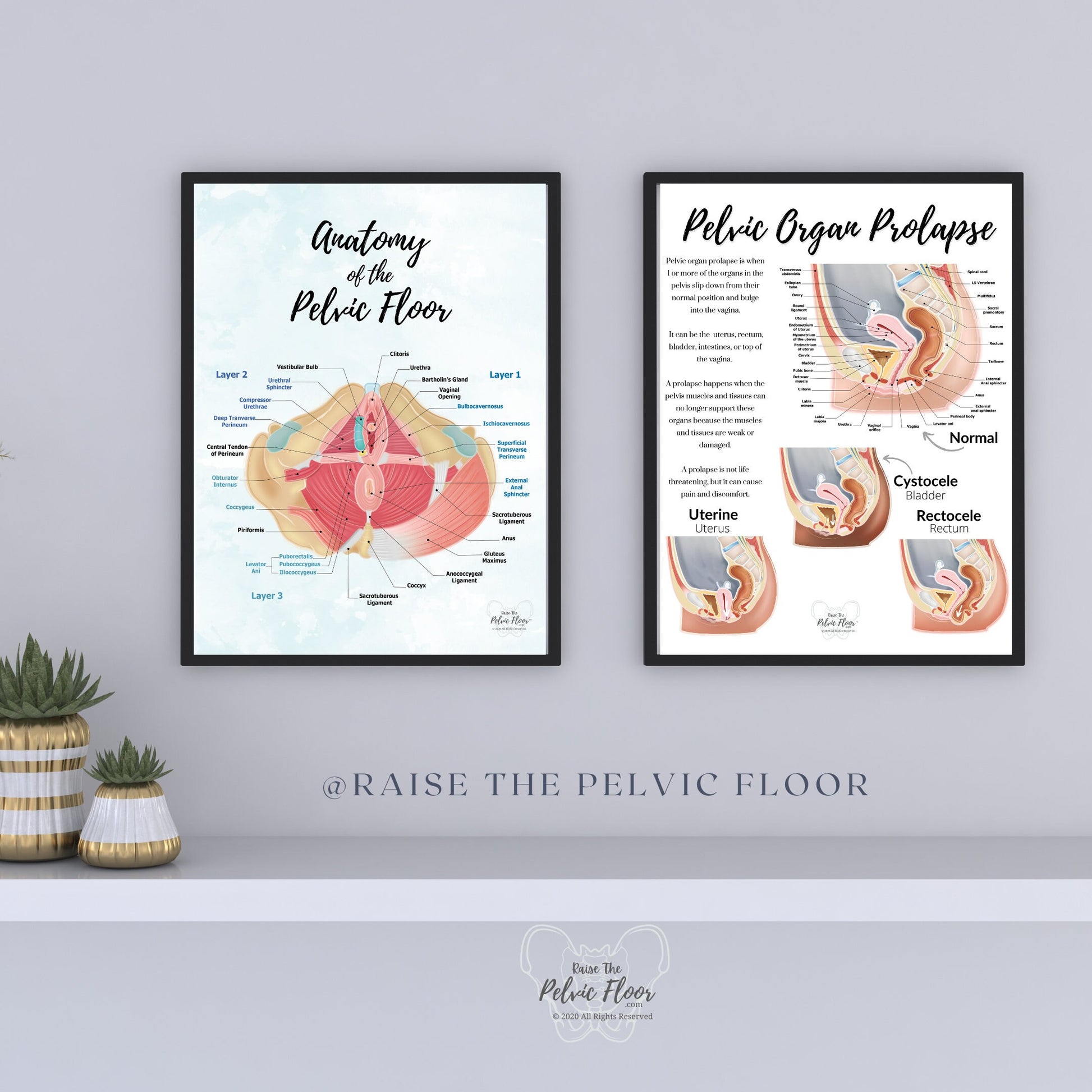 Prolapse Definition Art Print of Bladder, Rectum, & Uterus | Cystocele, Rectocele, and Uterine Prolapse | Pelvic Floor *Cultural Diversity