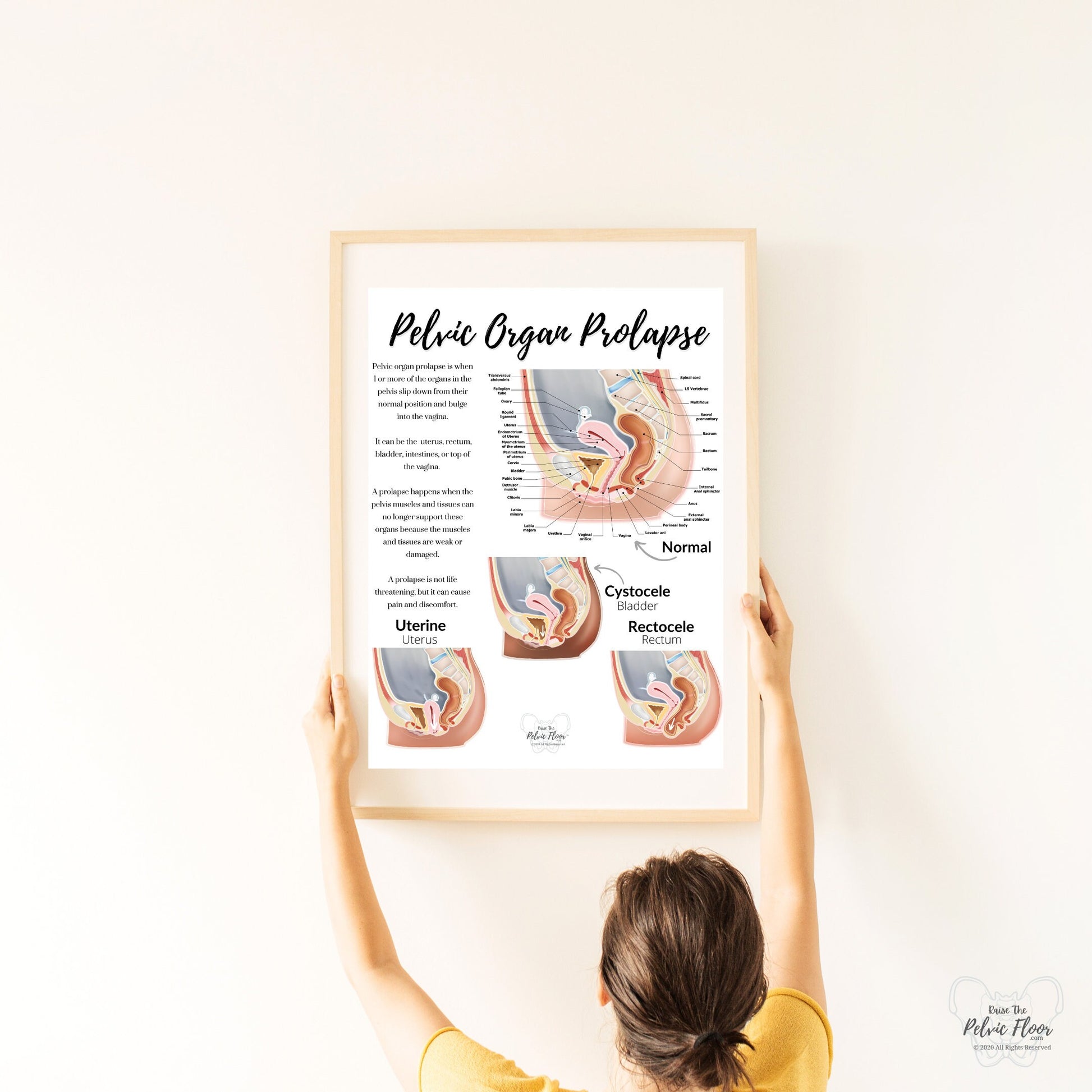 Prolapse Definition Art Print of Bladder, Rectum, & Uterus | Cystocele, Rectocele, and Uterine Prolapse | Pelvic Floor *Cultural Diversity